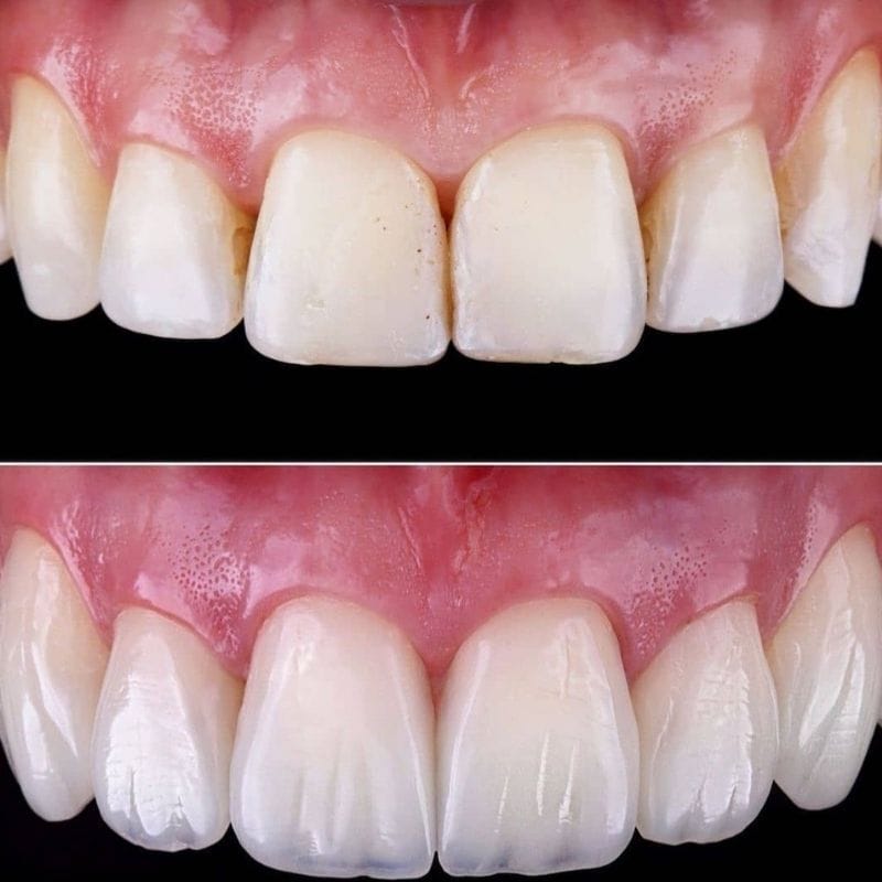 Faccette Dentali 3 3