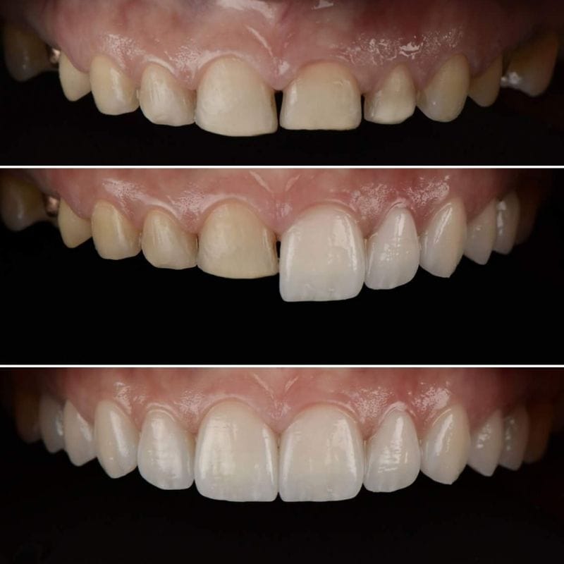 Faccette Dentali 4 4