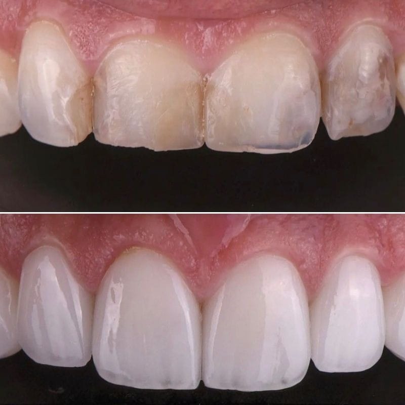 Faccette Dentali 5 5