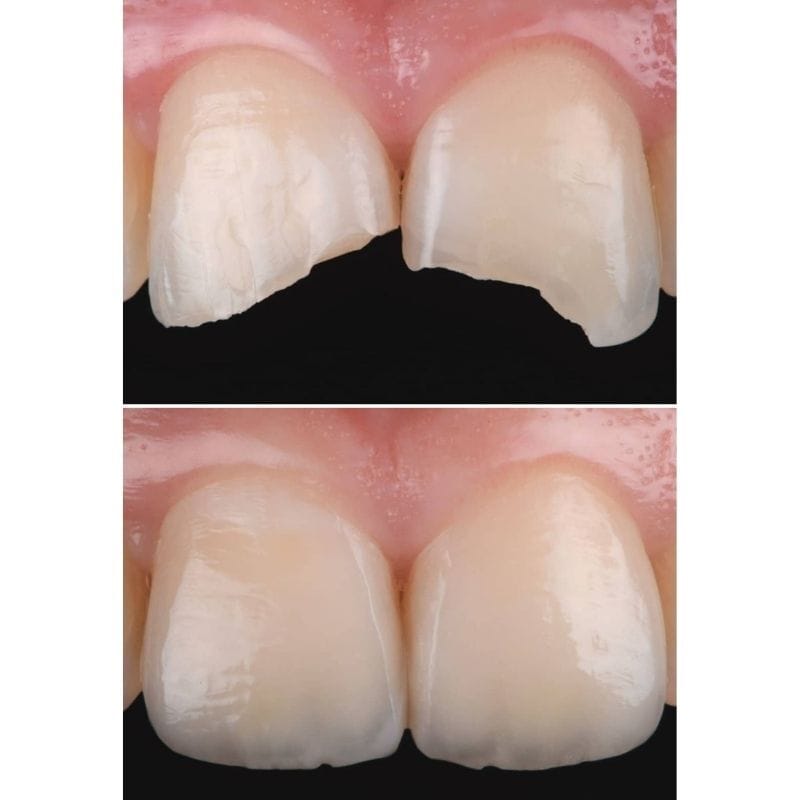Faccette Dentali 6 6