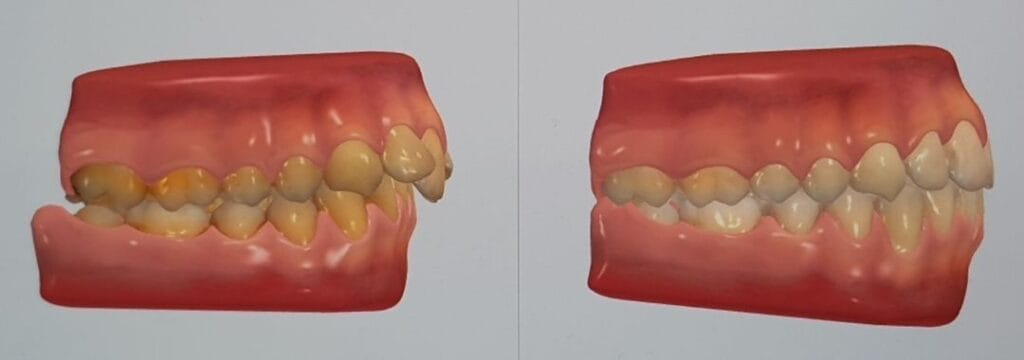 Ortodonzia Trasparente 2 CASO SU SCANNER