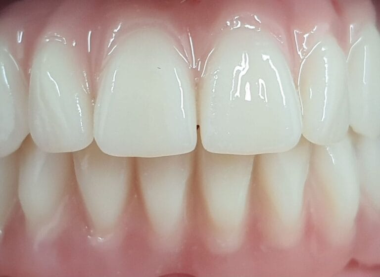 differenza tra protesi mobile e impianto dentale fisso