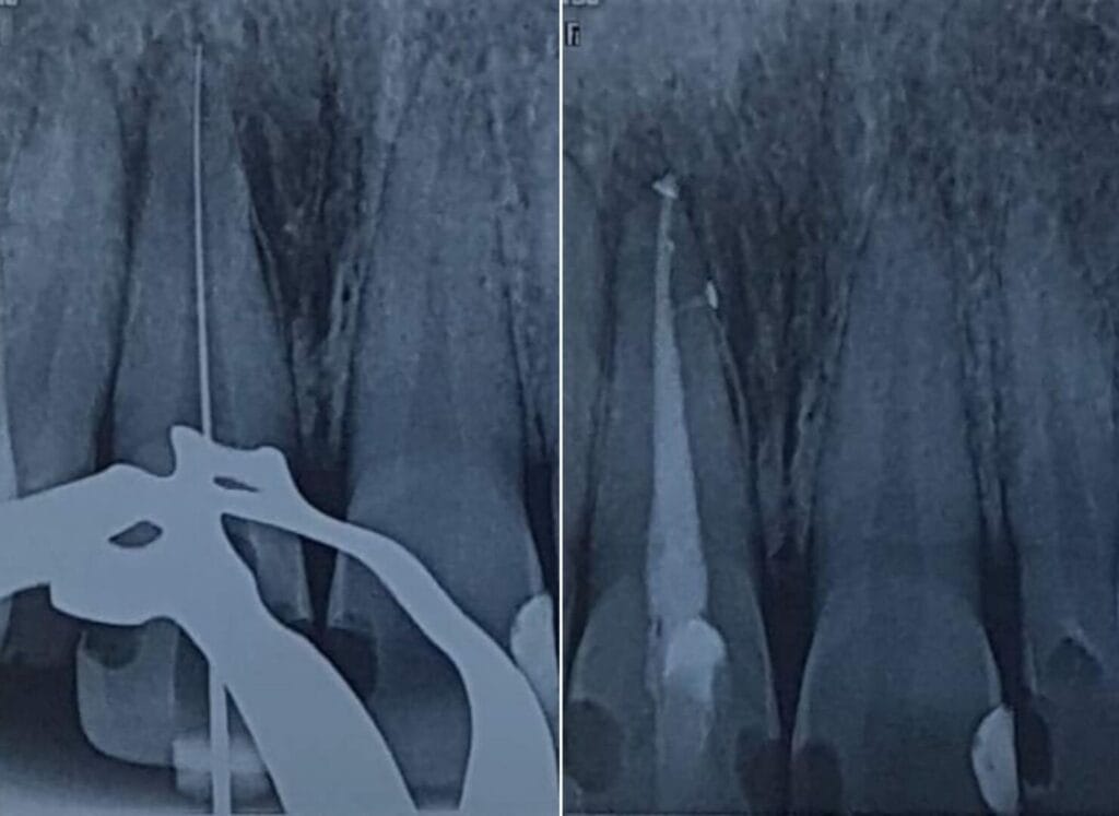 Endodonzia 6 devitalizzazione dente a legnano