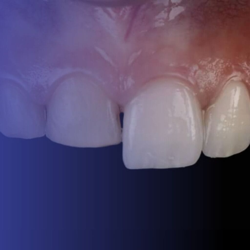Faccette Dentali 2 faccette dentali a legnano