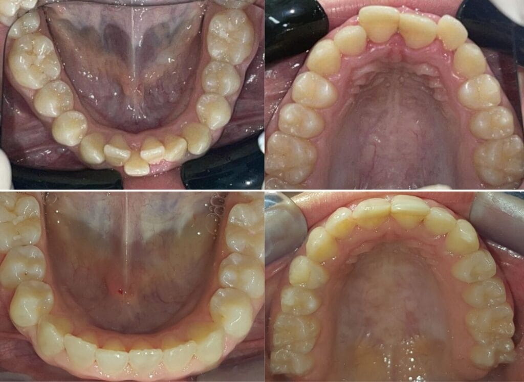 Ortodonzia Trasparente 8 PAZIENTE A