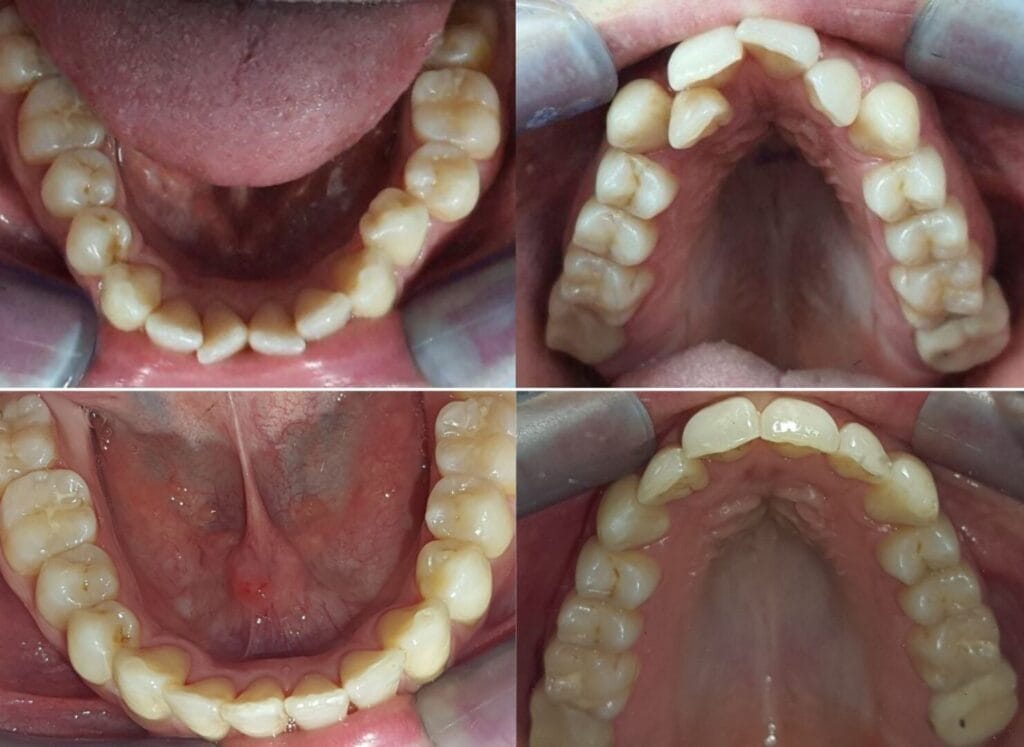 Ortodonzia Trasparente 10 PAZIENTE B