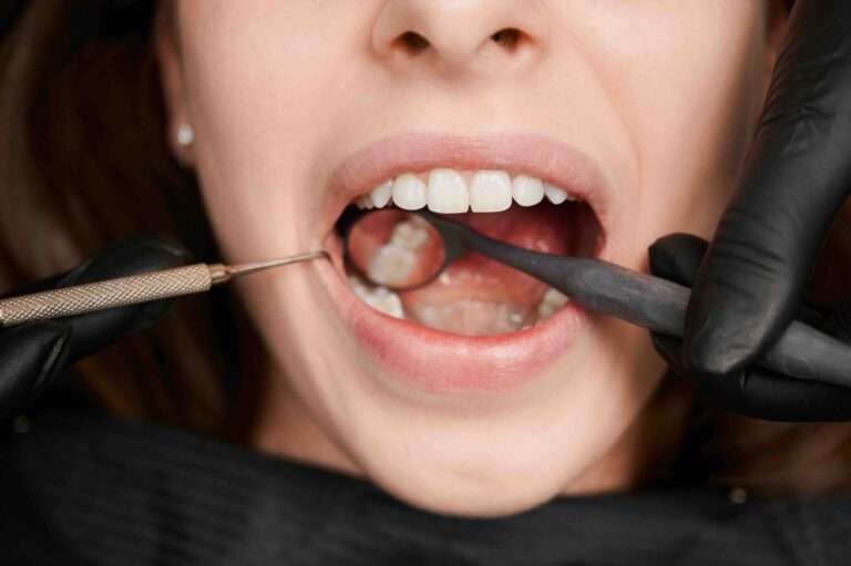 Quanto ci mette a uscire un dente del giudizio Quanto ci mette a uscire un dente del giudizio