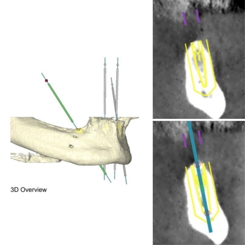 Implantologia 20 chirurgia guidata