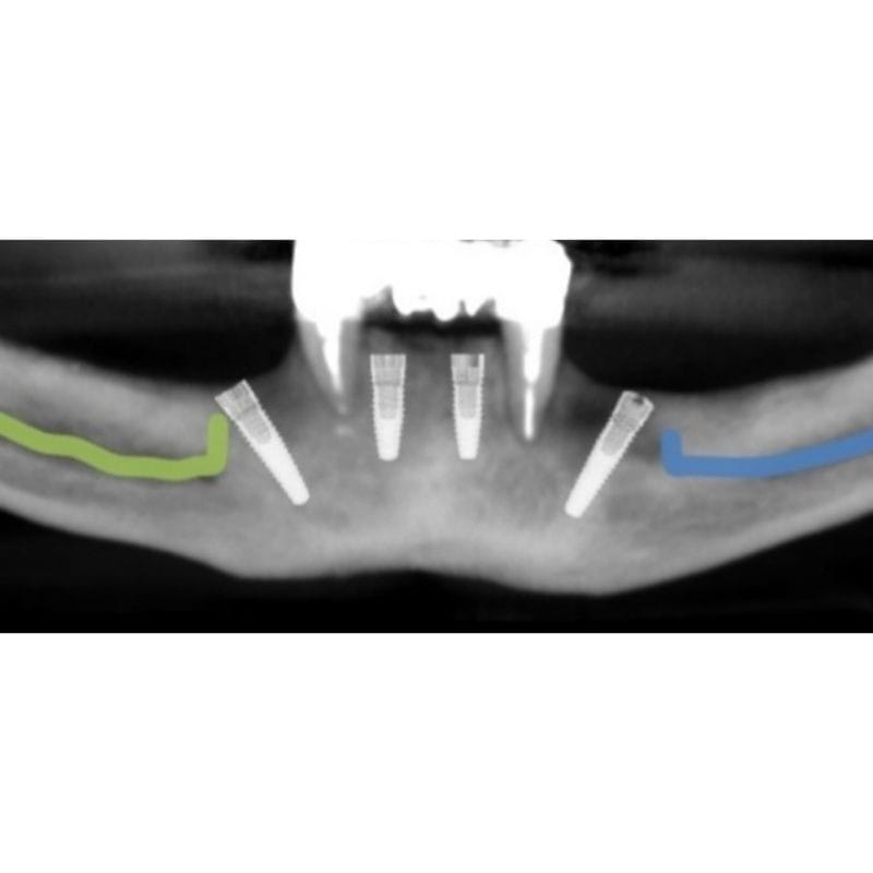 Implantologia 21 chirurgia guidata