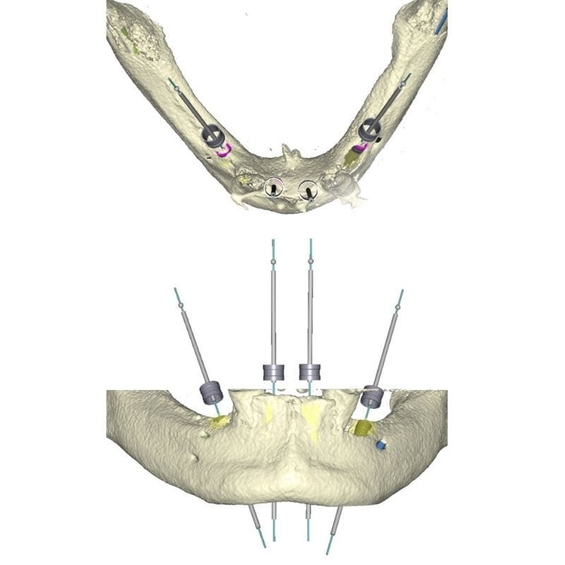 Implantologia 19 chirurgia guidata