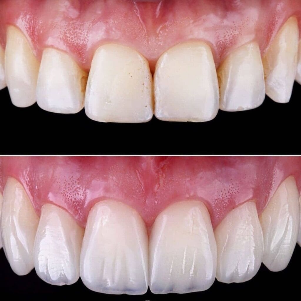 Con le Faccette Dentali si può Mangiare Normalmente? 2 con le faccette dentali si può mangiare normalmente